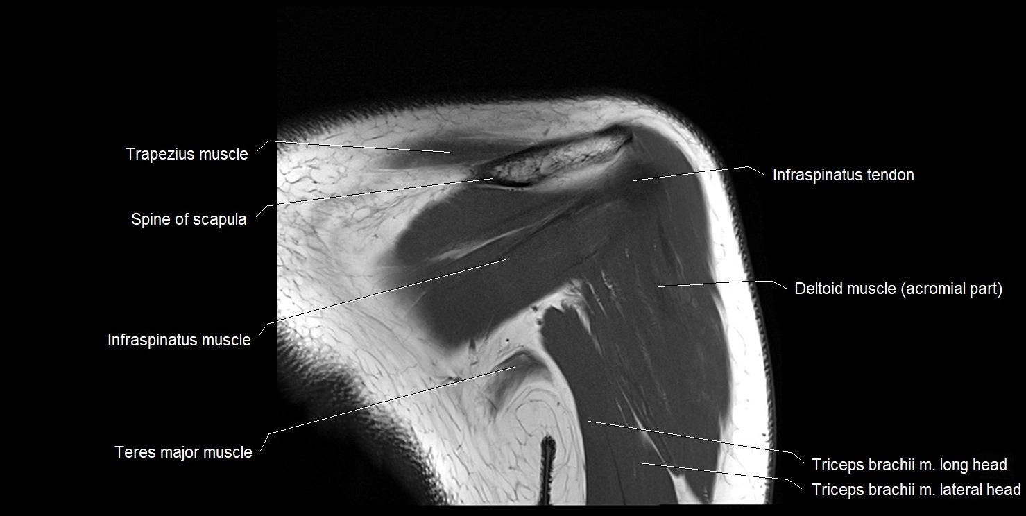 mri shoulder coronal cross sectional anatomy image 17.webp